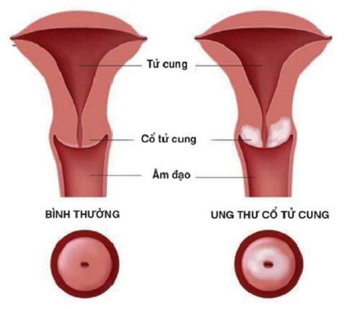 Thuốc điều trị ung thư cổ tử cung