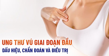 Thuốc mới cho bệnh ung thư vú giai đoạn đầu